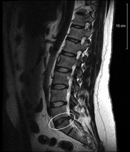 hernia discal l5 resonancia