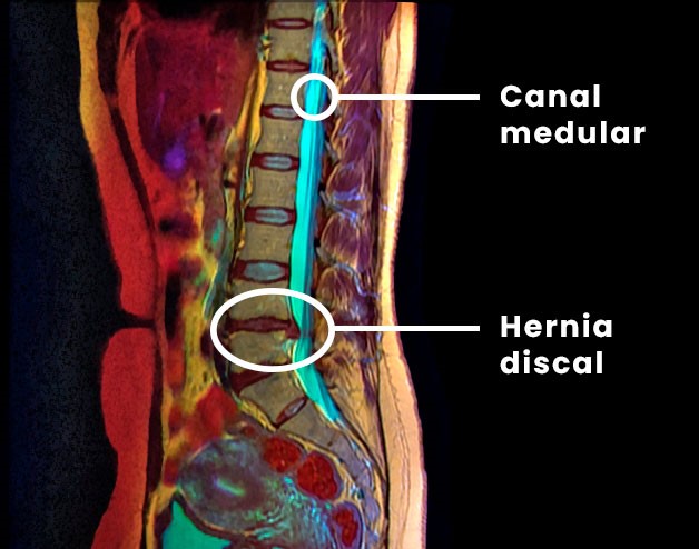 hernia de disco resonancia magnetica
