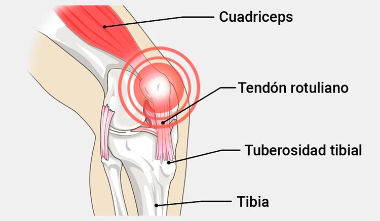 lesión rodilla padel